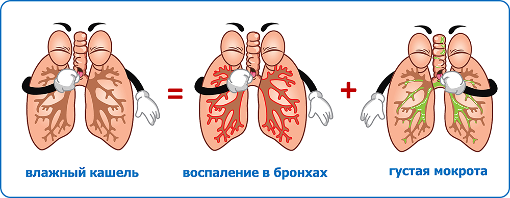 Хронический кашель - симптомы, причины и лечение у взрослых в Москве в «СМ-Клиника»
